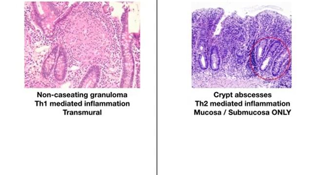 Inflammatory Bowel Disease (Crohn And Ulcerative Colitis)