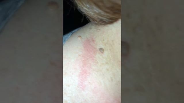 2/6/31 Talking about neck burnt from curling iron and small mishaps from targeting to my head