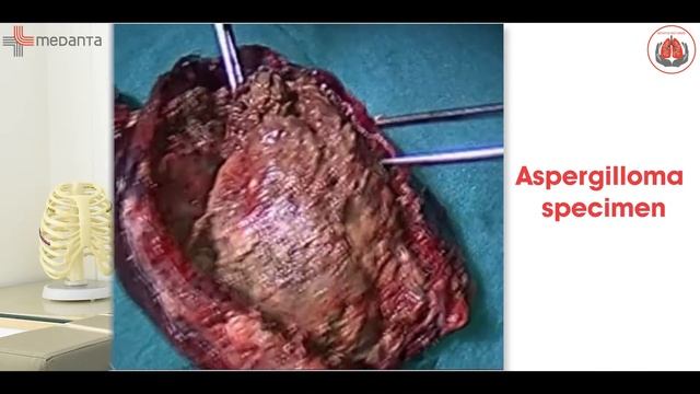 Aspergilloma (Fungus Ball) का इलाज क्या है ? | Thoracic Surgeon | Prof. (Dr.) Arvind Kumar | Medant