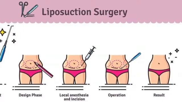 What is Liposuction - Fast Way of Removing Fat | liposuction consultation | lasik | Medical care