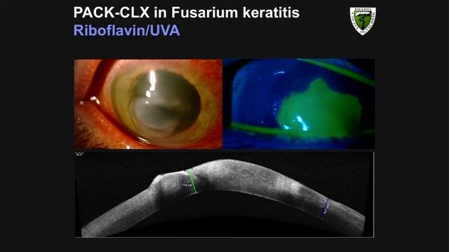 COR04 09   Section III Infectious Keratitis   Don’t Cross Me! Crosslinking for Infectious Keratitis