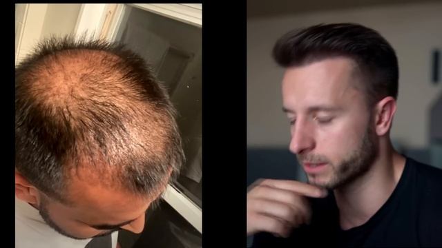6 Month Update: Hair Transplant with Hyperbaric Oxygen Therapy!!! 5000 Grafts Sapphire FUE!