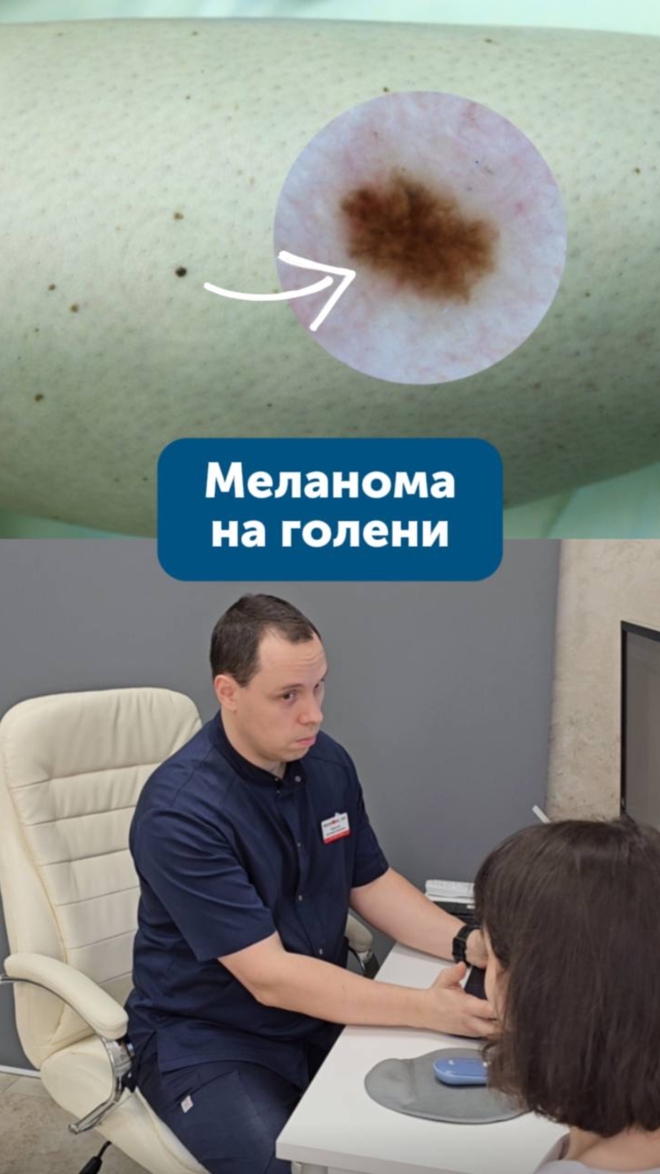 Меланома на голени