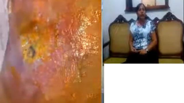 IMMUNOCAL Úlcera Varicosa y Pie Diabético
