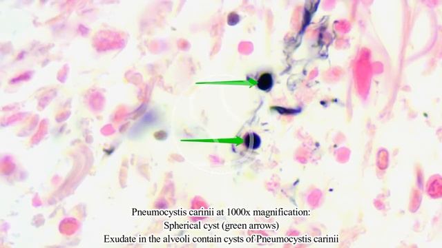 Pneumocystis carinii under the microscope with GMS-Haematoxylin and Eosin stain