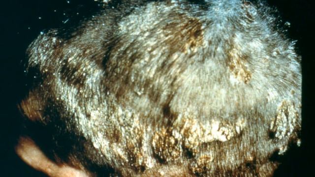 Dermatovenerologiya kafedrası - Cutaneous fungal infections. Lecture 3.