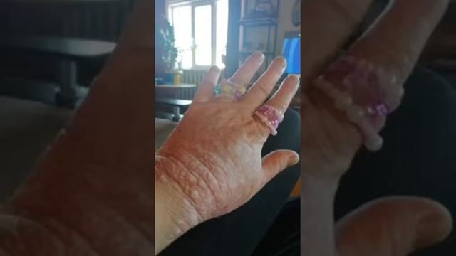 #псориаз Ия Афанасьева . Республика Саха .Страдала псориазом и псориартрическим артритом 20