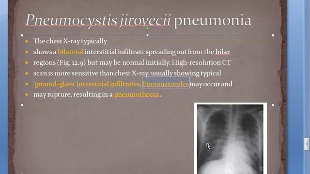 Medicine 0340 PNEUMOCYSTIS JIROVECI FUNGUS subacute PENUMONIA HIV COTRIMOXAZOLE antibiotic treatmen