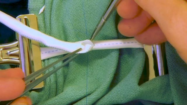 End to Side Anastomosis (Eric K. Peden, MD, M. Mujeeb Zubair, MD)