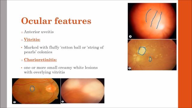 Endogenous Candida endophthalmitis #KanskiSeries