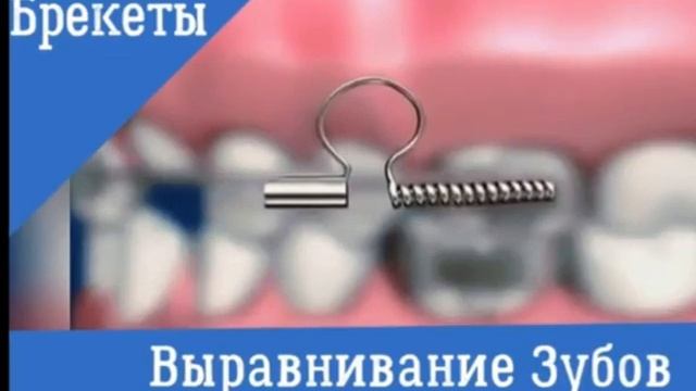 Изменение положения зубов с помощью брекетов || moscowsVtop