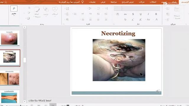 General Surgery / Wound Infection
