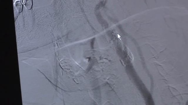 Carotid Artery Disease | The Medical Center 90-Seconds to Better Health