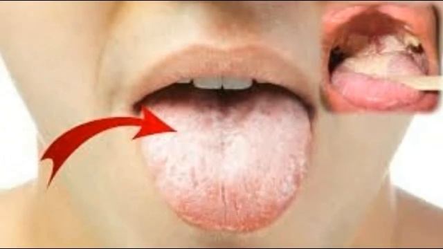 WOW ! BEST HOME REMEDIES FOR ORAL THRUSH