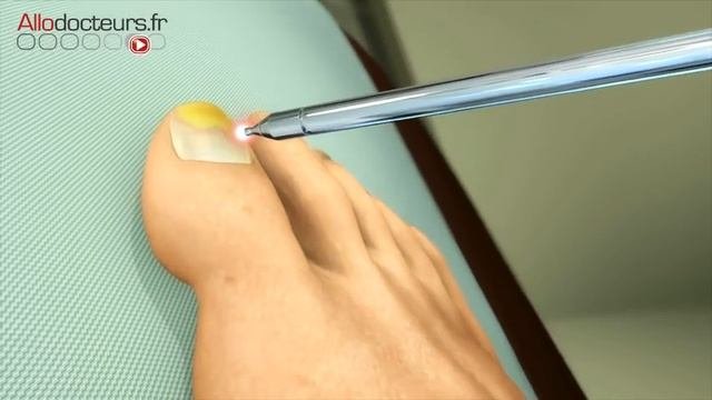 Mycoses Des Ongles :  Le Traitement Au Laser - Allô Docteurs