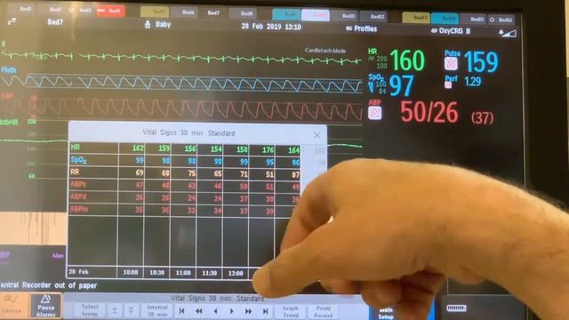 Physiologic Monitoring Part 2   Blood Pressure Histograms