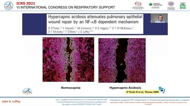 Гиперкапния при ОРДС John G Laffey  2021