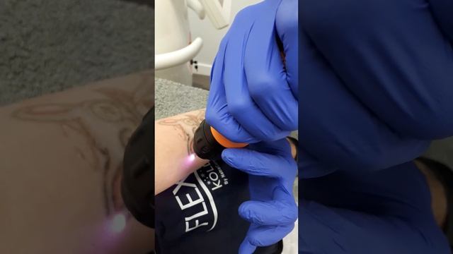 Laser Tattoo Removal