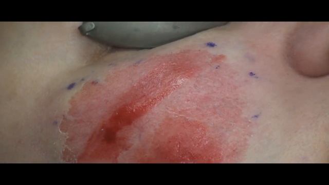 Scar Revision With CO2 Laser Part 03 by Dr.Young