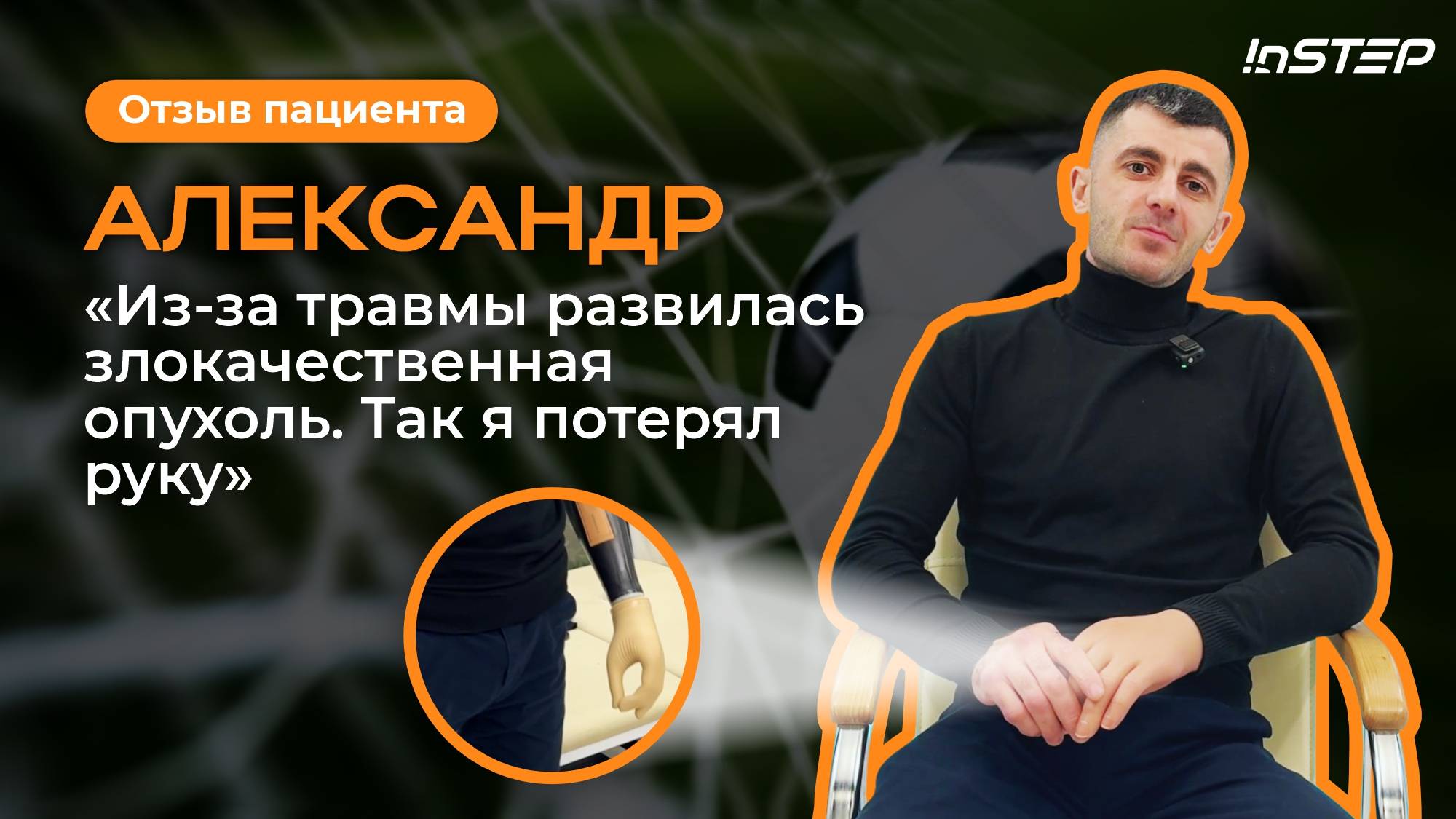 Из-за травмы развилась опухоль. Потерял руку. Сделали бионический протез. Отзыв пациента | Instep