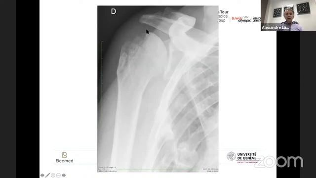 Recent Advances in Rotator Cuff Management