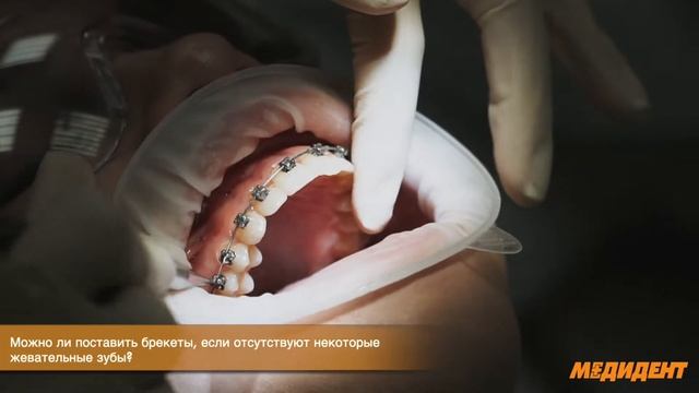 Брекеты часть 2 ортодонт Скакунова Ксения