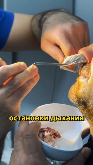 Результат на 2 день после септопластики и шейверной полипотомии. Лучший лор-хирург-Эльдар Мазумович