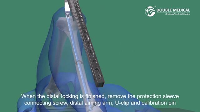 Double Medical Universal Cannulated Tibial Nail （UTN） II