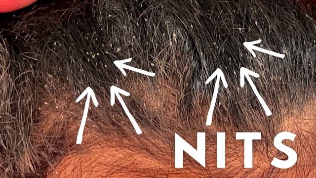 Brown Nits and Lice Eggs: What it Means