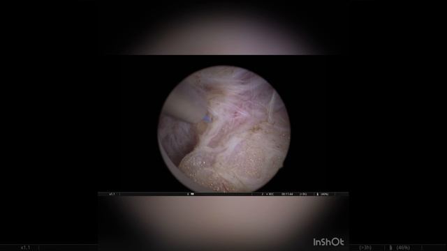 Цистоскопия и необычное образование в мочевом пузыре