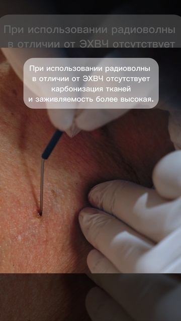 Удаление радиоволной.