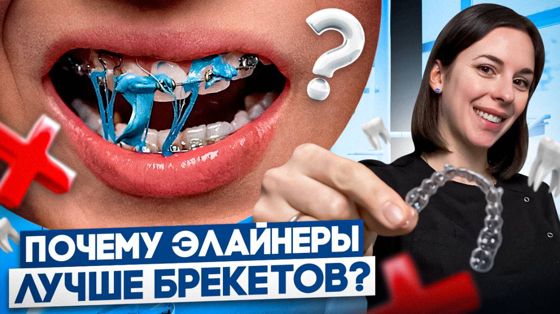 Выравнивают ли элайнеры зубы? ТОП 5 ПРИЧИН установить ЭЛАЙНЕРЫ, вместо брекетов!