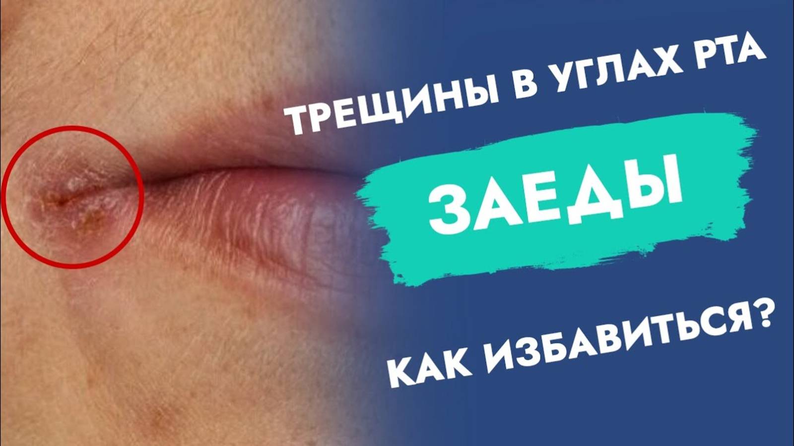 Болят и воспаляются углы рта. Причины и лечение!