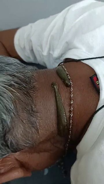 Cervical Spondylosis Treat@ Ayurved Leech therapy