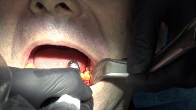 Implant placement of 2 GM Grand Morse Helix to restore two molars.