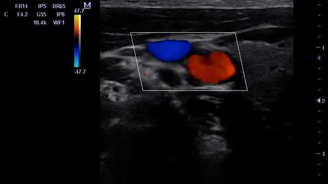 M5 Hand carried Color Doppler  Products   Mindray 6