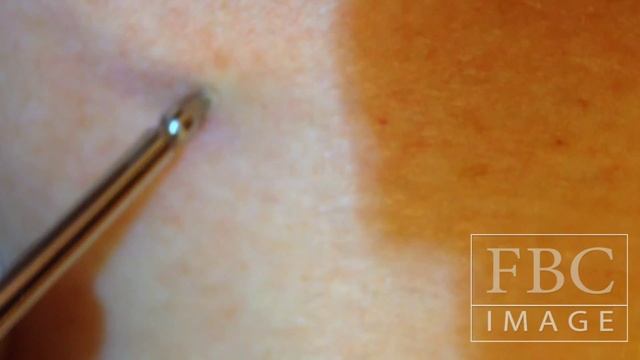 NUEVAS TECNICAS NEVUS RUBI CORTESIA Dr. NESTOR JAIRO RUBIO
