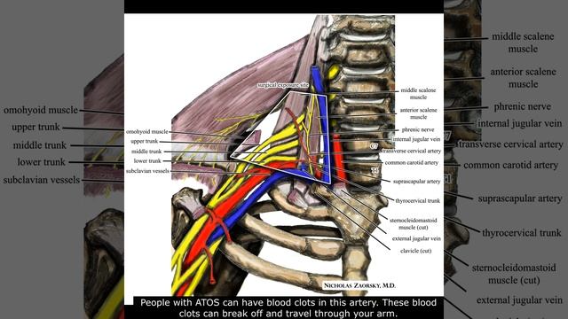 Arterial Thoracic Outlet Syndrome