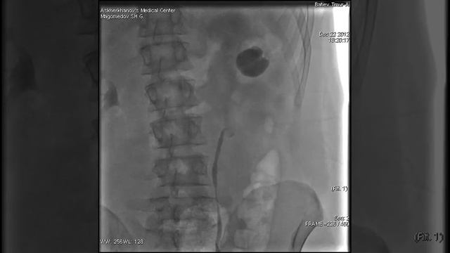 МЦА. Интервенционная восходящая уретерография.mpg
