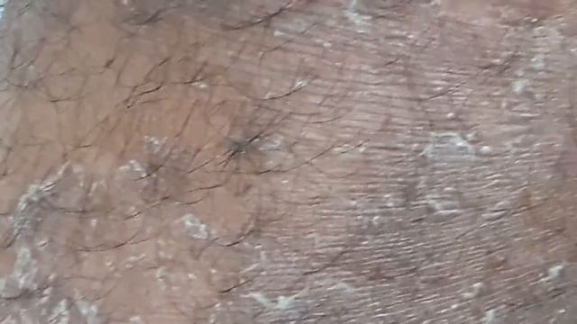 Tinea Corporis