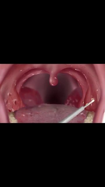 ystic Acne Extraction This Week, Blackheads Removal, Blackhead Extraction