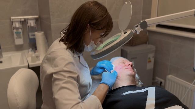 Коррекция рубцов постакне филлером Sofiderm