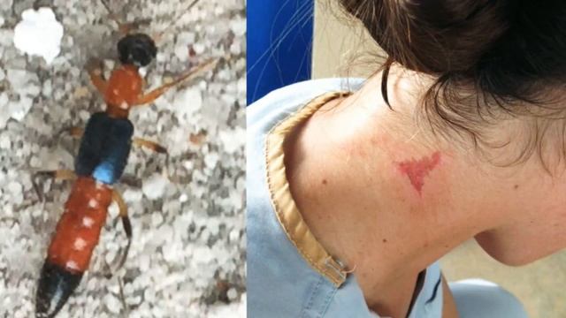 యాసిడ్ పురుగు పాకిందా ఇదే ఆ పురుగు /dr dorababu  | insect crawling, | paedurus dermatitis Telugu