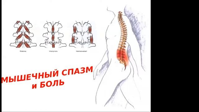 Здоровый позвоночник. Спину прихватило