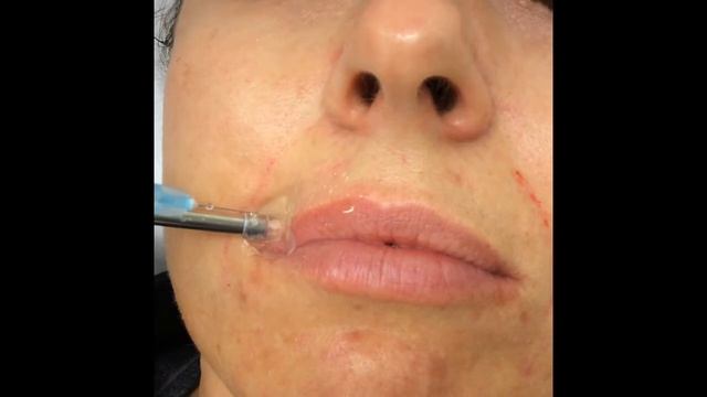 Mesotherapy at Bodyvie