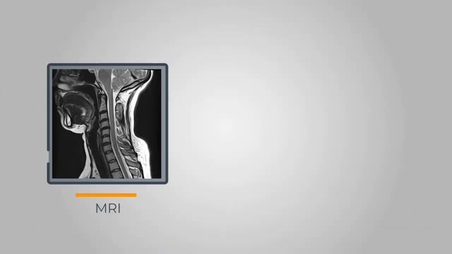 CERVICAL RADICULOPATHY: Common Symptoms and Treatment Options - Dr. Javier Reto