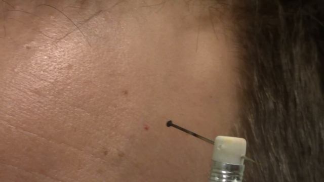 How to remove Red Skin Dots at home Quick & Easy Cherry Angioma treatment