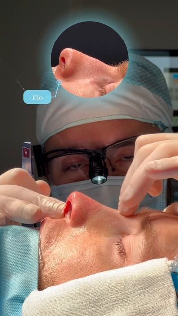 Вторичная мужская риносептопластика 👃🏼