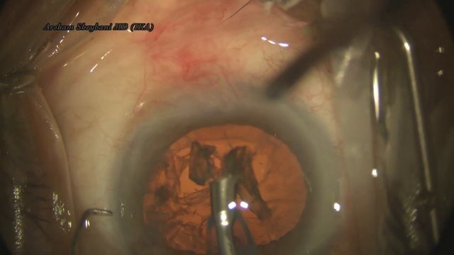 Iris prolapse management
