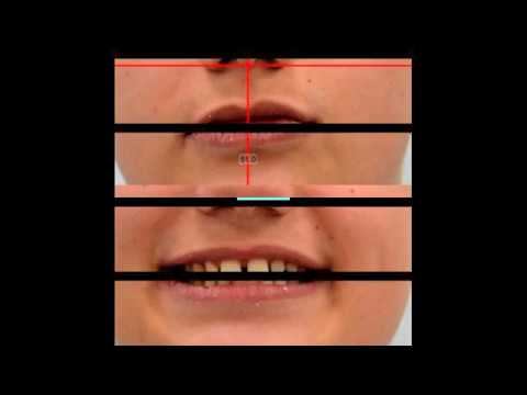 Редкие зубы как исправить? Орто Центр Саратова